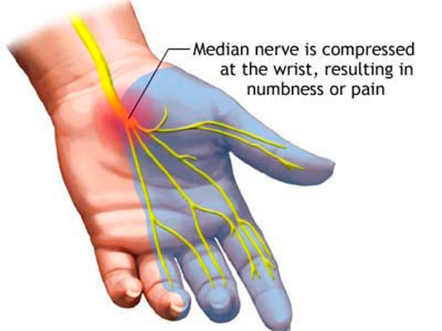 Carpal-tunnel-syndrome