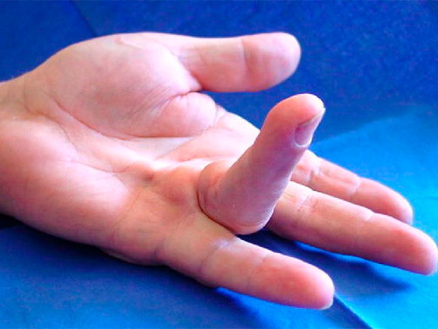 Contraction of finger due to Dupuytren's disease