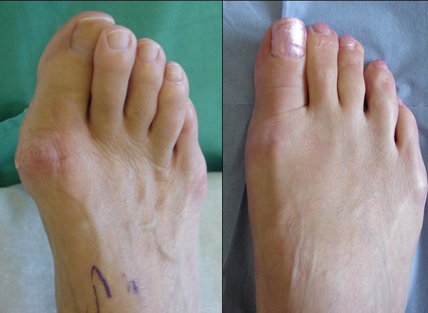 Picture of hallux valgus before and after surgery