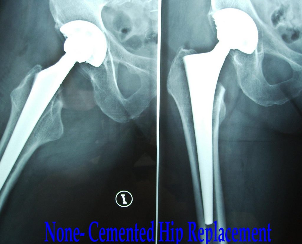 Picture of a none cemented total hip replacement