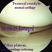 Arthroscopic picture of the inside of a knee joint with damaged meniscus