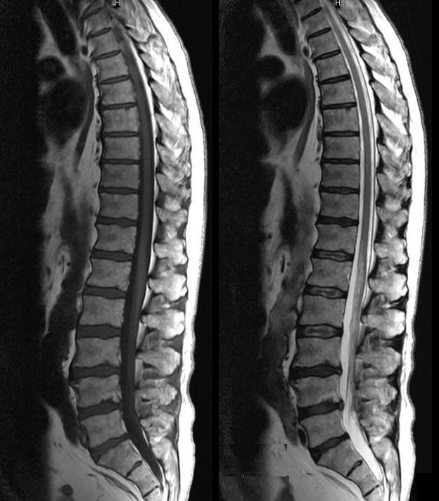 Picture of normal MRI scan of lower back