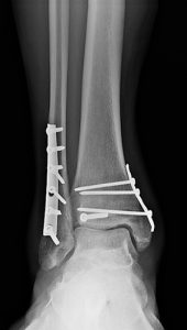 X-ray of repaired ankle fracture