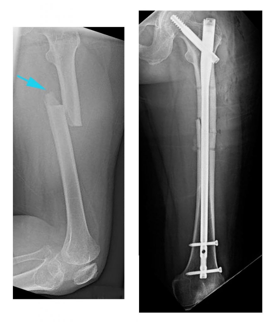 Röntgenbild eines Oberschenkelknochen- Bruch