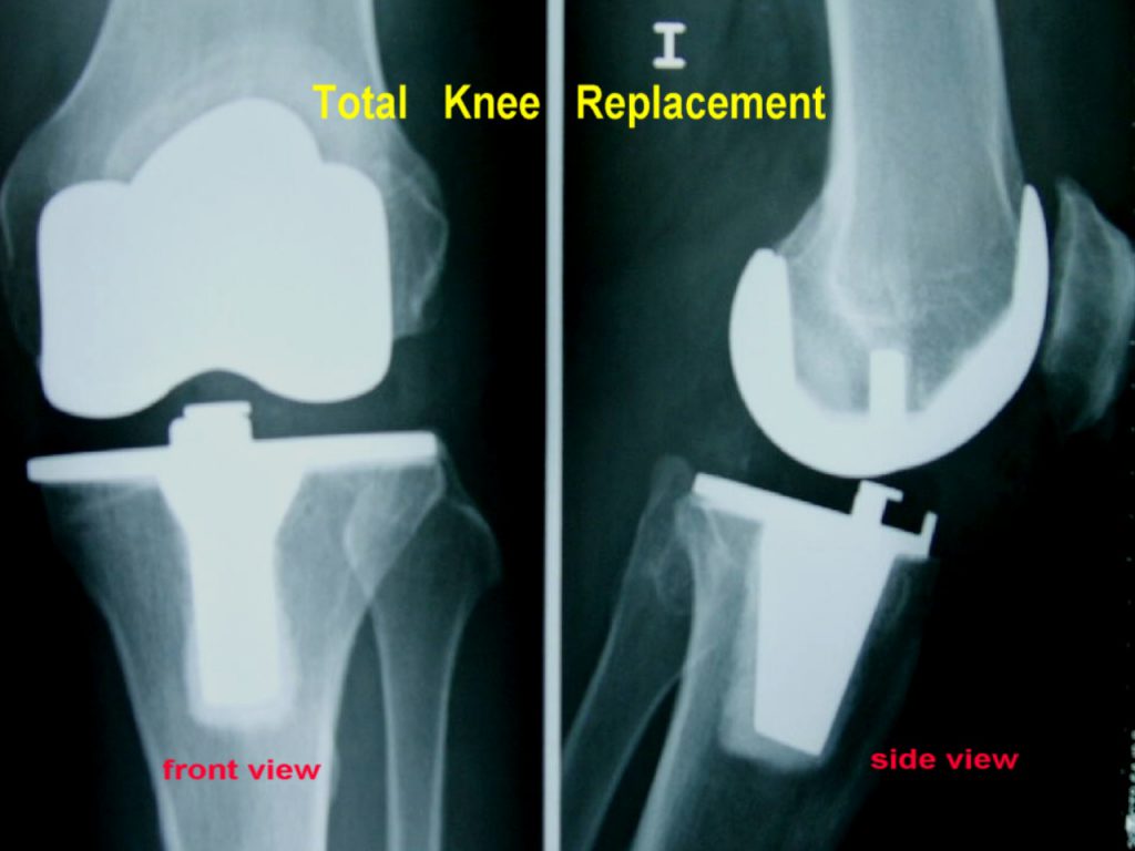 X-ray total knee replacement