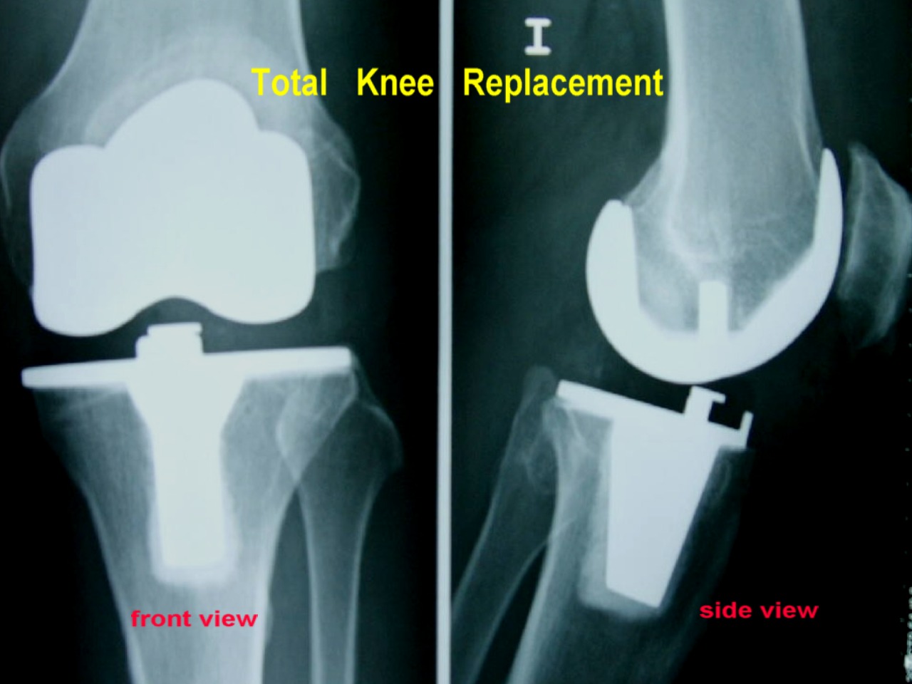 Picture of X-ray total knee replacement